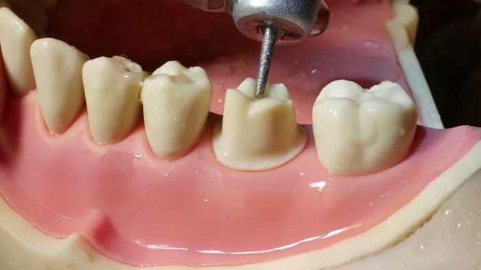 Bọc răng sứ có đau không? Làm thế nào để hạn chế đau khi bọc răng sứ?